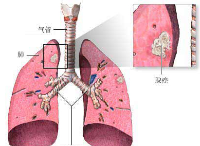 肺癌診斷